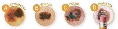 Asymmetry (one half does not mirror the other) Border (irregular outer edge) Color (two or more colors) Diameter (6 mm or greater, or the size of a pencil eraser) Evolving (a mole that is changing)