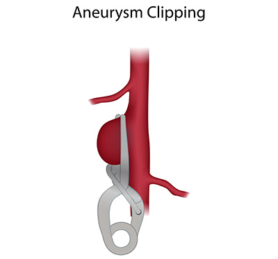 Aneurysm Clipping
