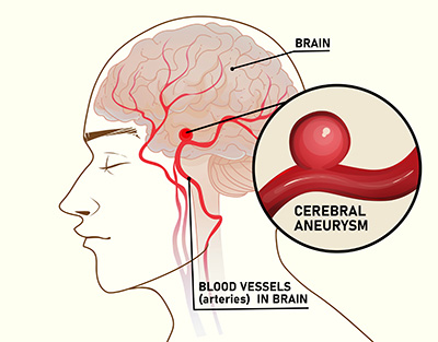 Brain Aneurysm