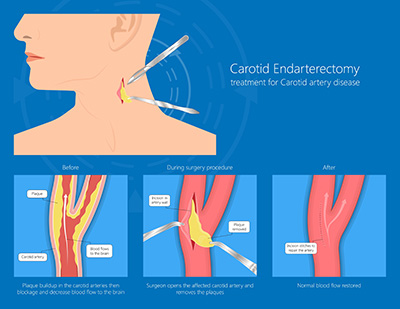 Carotid Endarterectomy