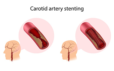Carotid Stenting