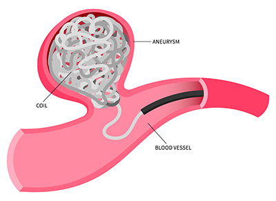 Endovascular Coiling